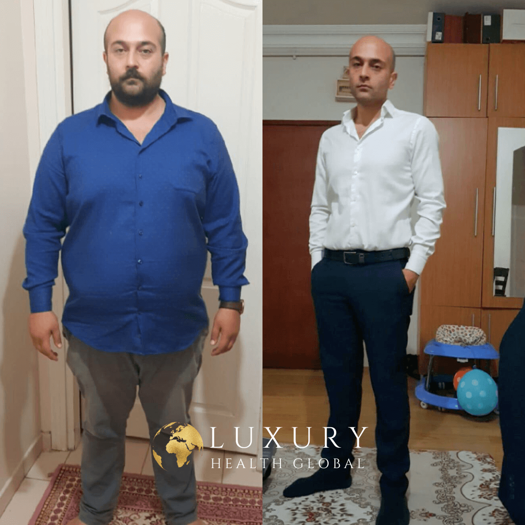Obesity Surgery - 1 Yıllık Sonuç, 60.4 kg Kayıp Öncesi