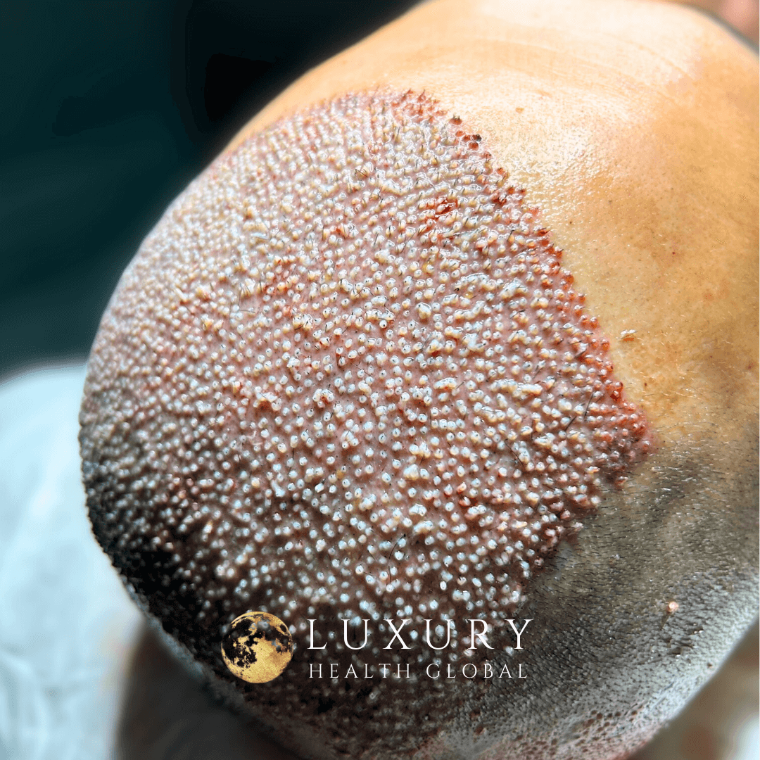FUE Hair Transplant - 4000 Greft Öncesi