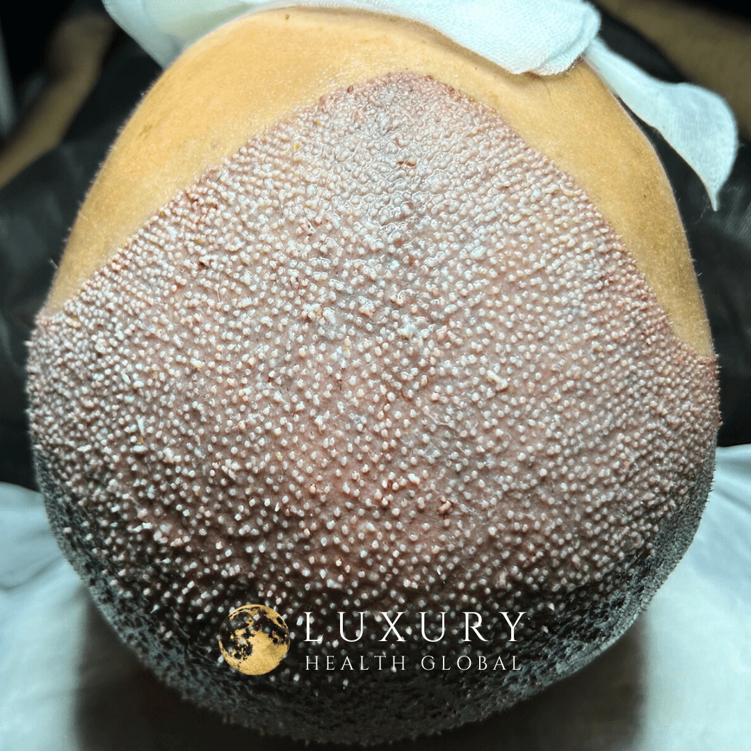 FUE Hair Transplant - 5500 Greft Öncesi
